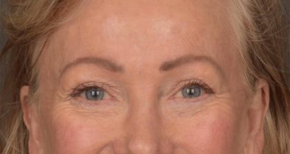 Blepharoplasty Before & After Patient #3124