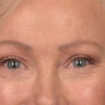 Blepharoplasty Before & After Patient #3124