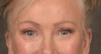 Blepharoplasty Before & After Patient #3124