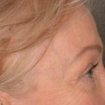 Blepharoplasty Before & After Patient #3124