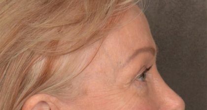 Blepharoplasty Before & After Patient #3124