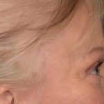 Blepharoplasty Before & After Patient #3124