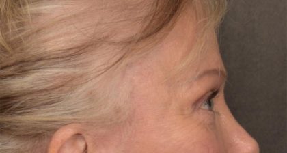 Blepharoplasty Before & After Patient #3124