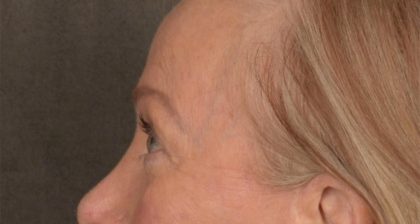 Blepharoplasty Before & After Patient #3124