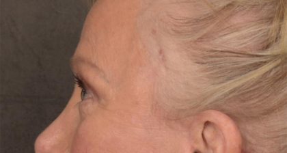 Blepharoplasty Before & After Patient #3124