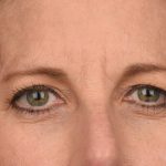 Blepharoplasty Before & After Patient #3125