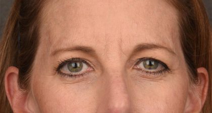 Blepharoplasty Before & After Patient #3125
