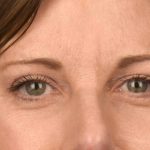Blepharoplasty Before & After Patient #3125