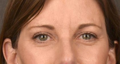 Blepharoplasty Before & After Patient #3125