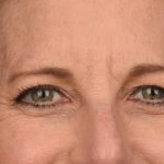Blepharoplasty Before & After Patient #3125