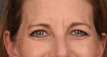 Blepharoplasty Before & After Patient #3125