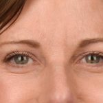 Blepharoplasty Before & After Patient #3125