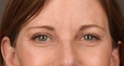 Blepharoplasty Before & After Patient #3125