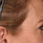 Blepharoplasty Before & After Patient #3125