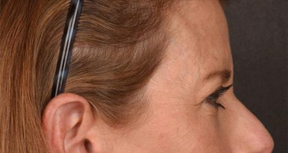 Blepharoplasty Before & After Patient #3125
