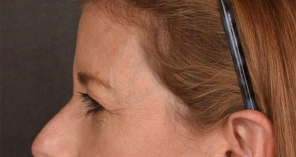 Blepharoplasty Before & After Patient #3125