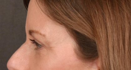 Blepharoplasty Before & After Patient #3125