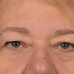 Blepharoplasty Before & After Patient #3126