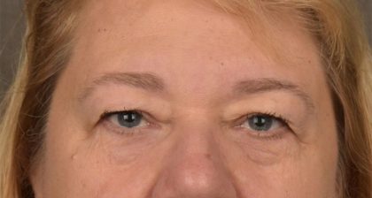 Blepharoplasty Before & After Patient #3126
