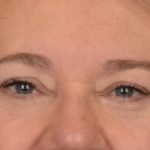 Blepharoplasty Before & After Patient #3126