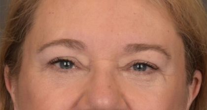 Blepharoplasty Before & After Patient #3126