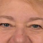 Blepharoplasty Before & After Patient #3126