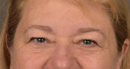 Blepharoplasty Before & After Patient #3126