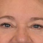 Blepharoplasty Before & After Patient #3126