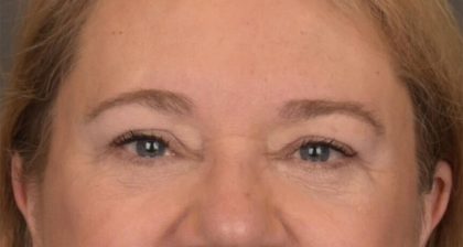Blepharoplasty Before & After Patient #3126