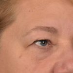 Blepharoplasty Before & After Patient #3126