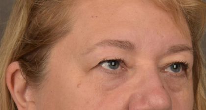 Blepharoplasty Before & After Patient #3126