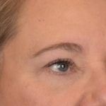 Blepharoplasty Before & After Patient #3126