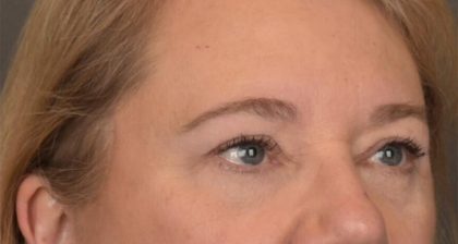 Blepharoplasty Before & After Patient #3126