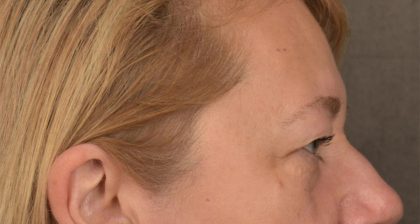 Blepharoplasty Before & After Patient #3126