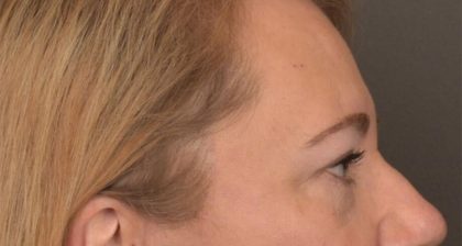 Blepharoplasty Before & After Patient #3126