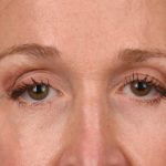 Blepharoplasty Before & After Patient #3127