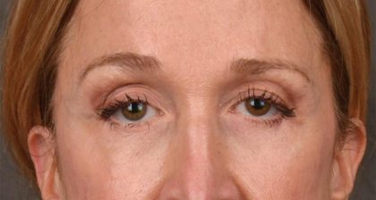 Blepharoplasty Before & After Patient #3127