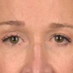 Blepharoplasty Before & After Patient #3127