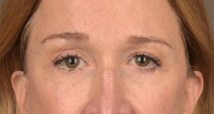 Blepharoplasty Before & After Patient #3127