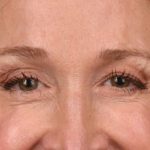 Blepharoplasty Before & After Patient #3127