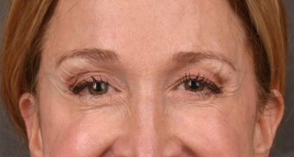 Blepharoplasty Before & After Patient #3127