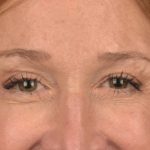 Blepharoplasty Before & After Patient #3127