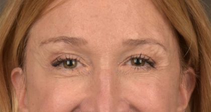 Blepharoplasty Before & After Patient #3127