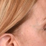 Blepharoplasty Before & After Patient #3127