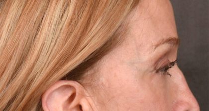 Blepharoplasty Before & After Patient #3127
