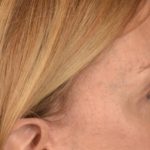 Blepharoplasty Before & After Patient #3127