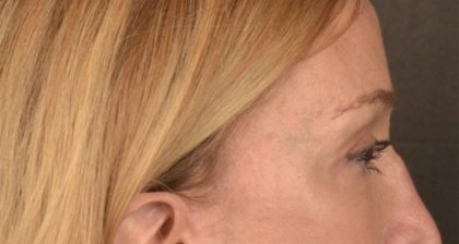 Blepharoplasty Before & After Patient #3127