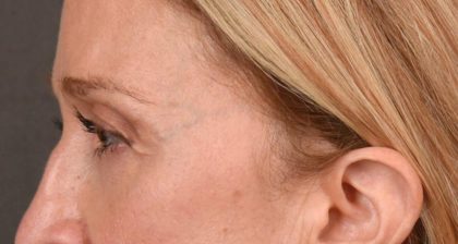 Blepharoplasty Before & After Patient #3127