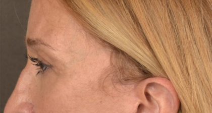 Blepharoplasty Before & After Patient #3127