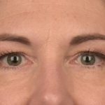 Blepharoplasty Before & After Patient #3128